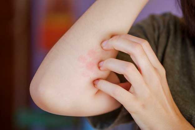 Лечение аллергического зуда кожи